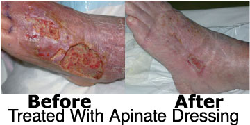 before and after wound