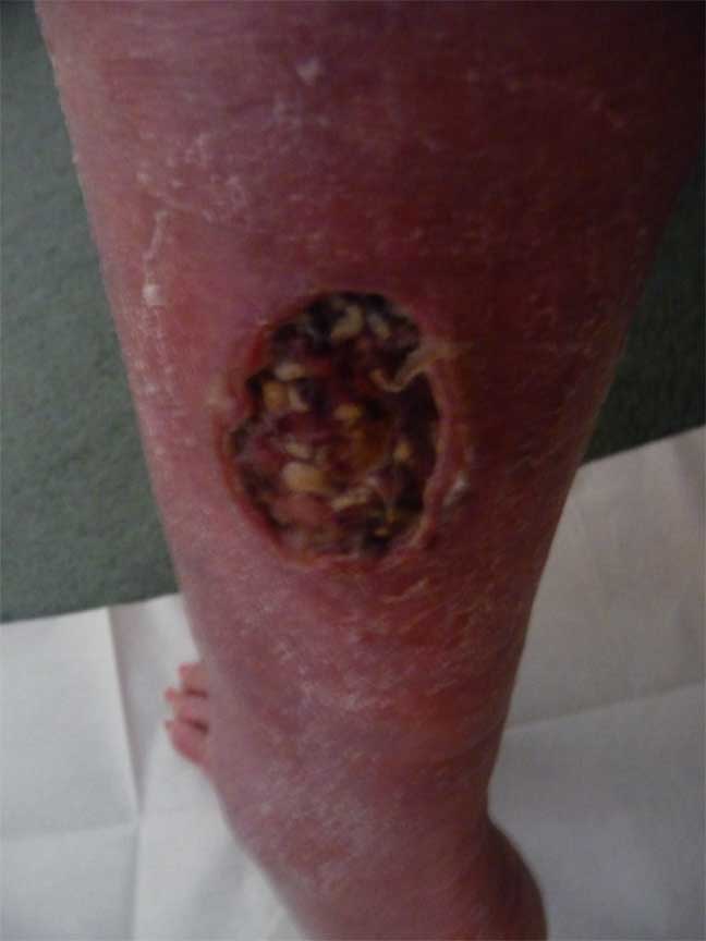 before wound